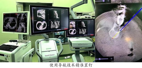 導航系統(tǒng)助兒童脊柱手術更精準 復旦兒科暑期手術刷新記錄